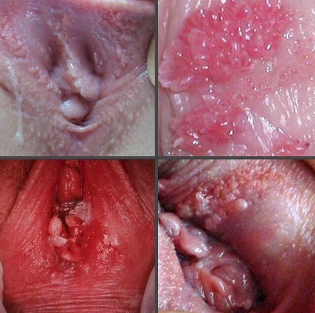 Afërfaqja e papillomave në vaginë