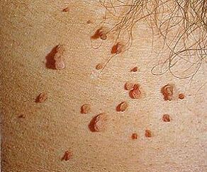 papillomavirusi i njeriut në lëkurë