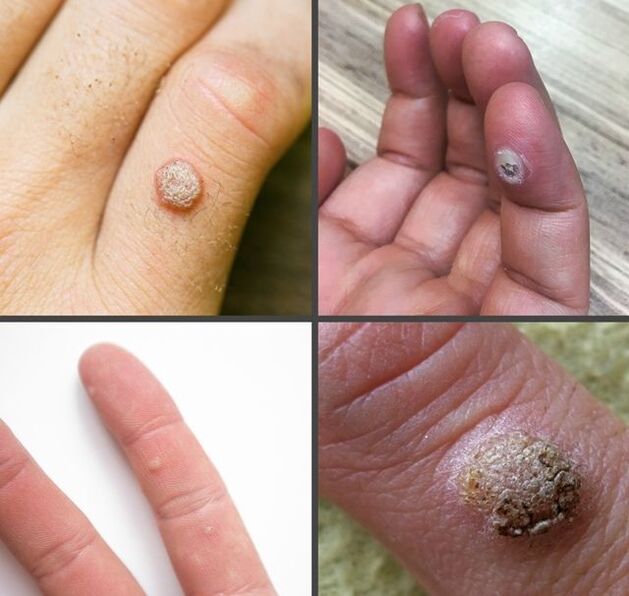 Llojet e zakonshme të lythave në gishta