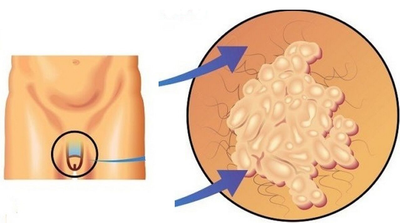 papilloma në penis